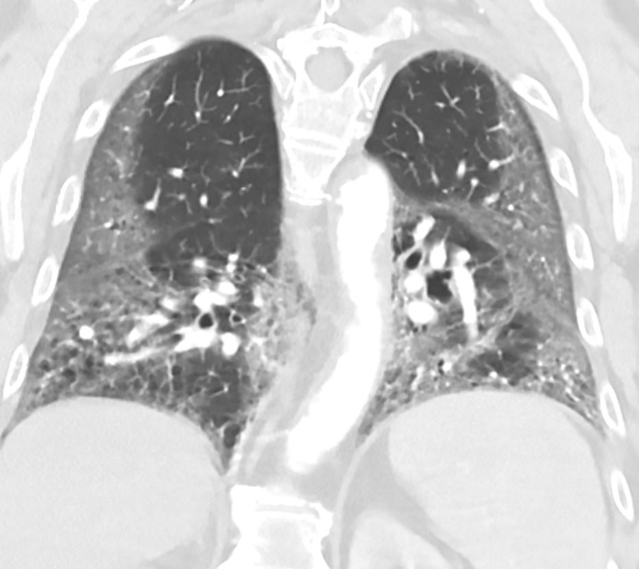A CT scan of a patient with pneumonia caused by COVID-19